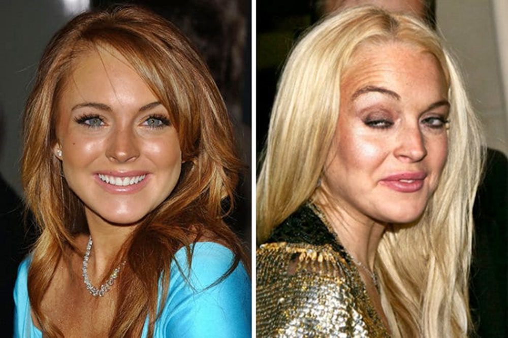 Lindsay Lohan 35 éves korára teljesen felismerhetetlenné vált