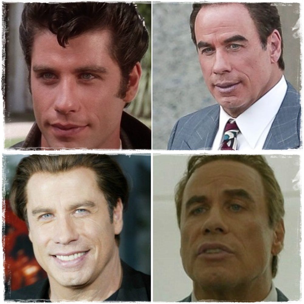 Sajnos John Travolta is a plasztikai műtétek áldozata lett