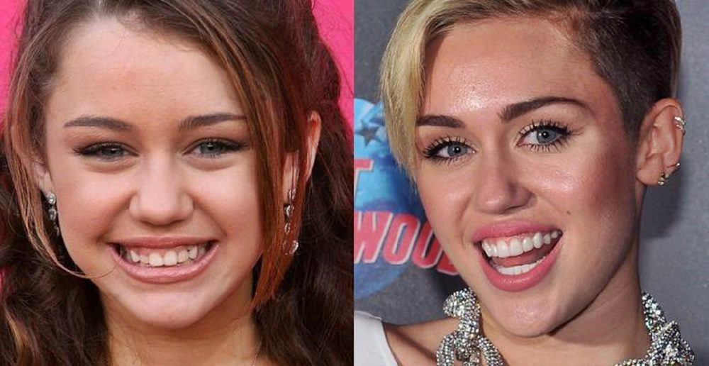 A nagy változás - Miley Cyrus a fogorvos előtt és után