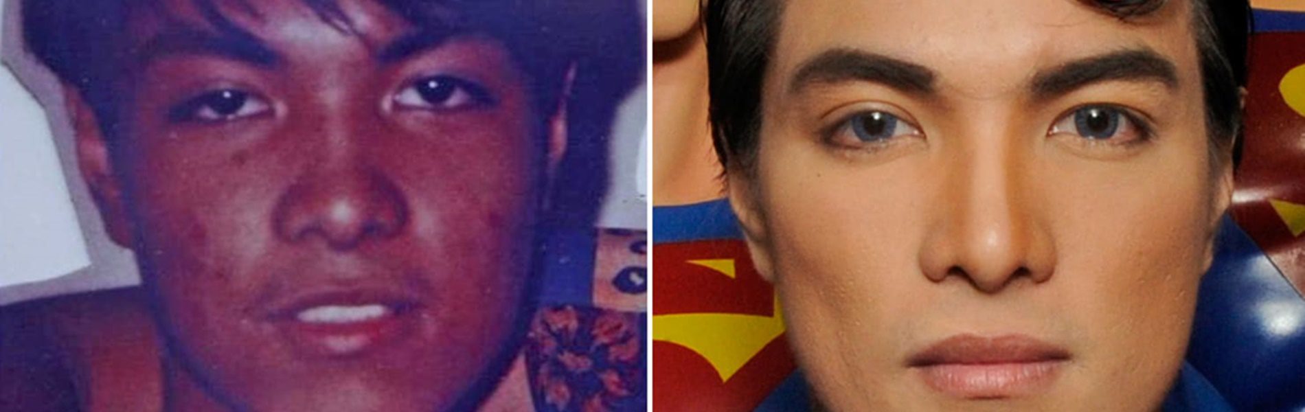 Döbbenet! Superman szeretett volna lenni, felismerhetetlenné vált a sok plasztikától