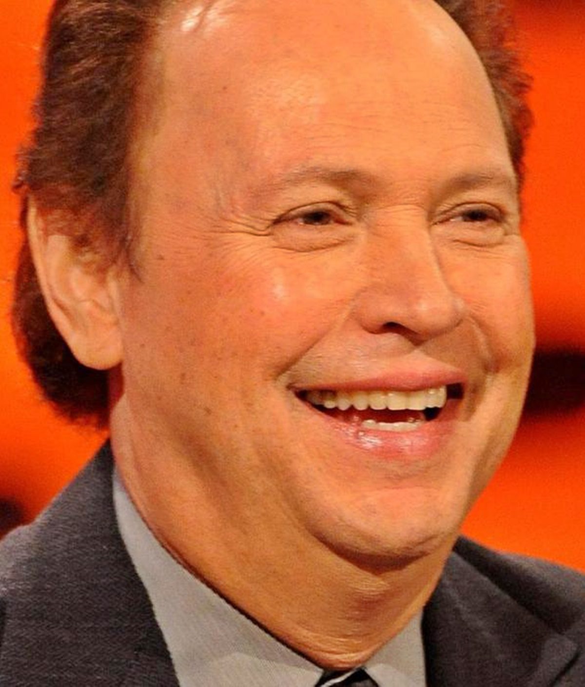 Billy Crystal arcát teljesen tönkretette a plasztika