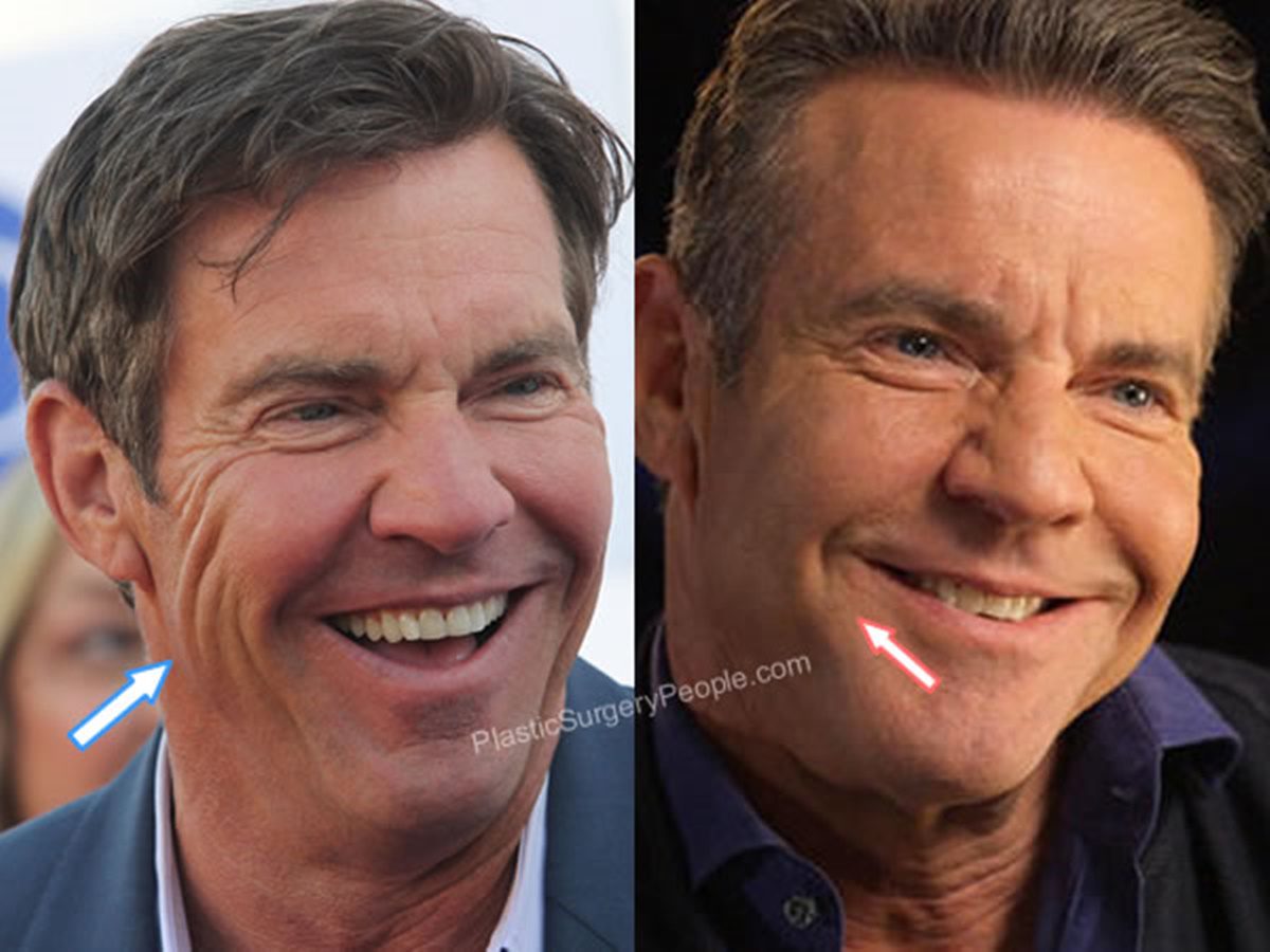 Dennis Quaid az egyik legvonzóbb férfiszínész volt, most meg már rá sem ismersz a sok botoxtól