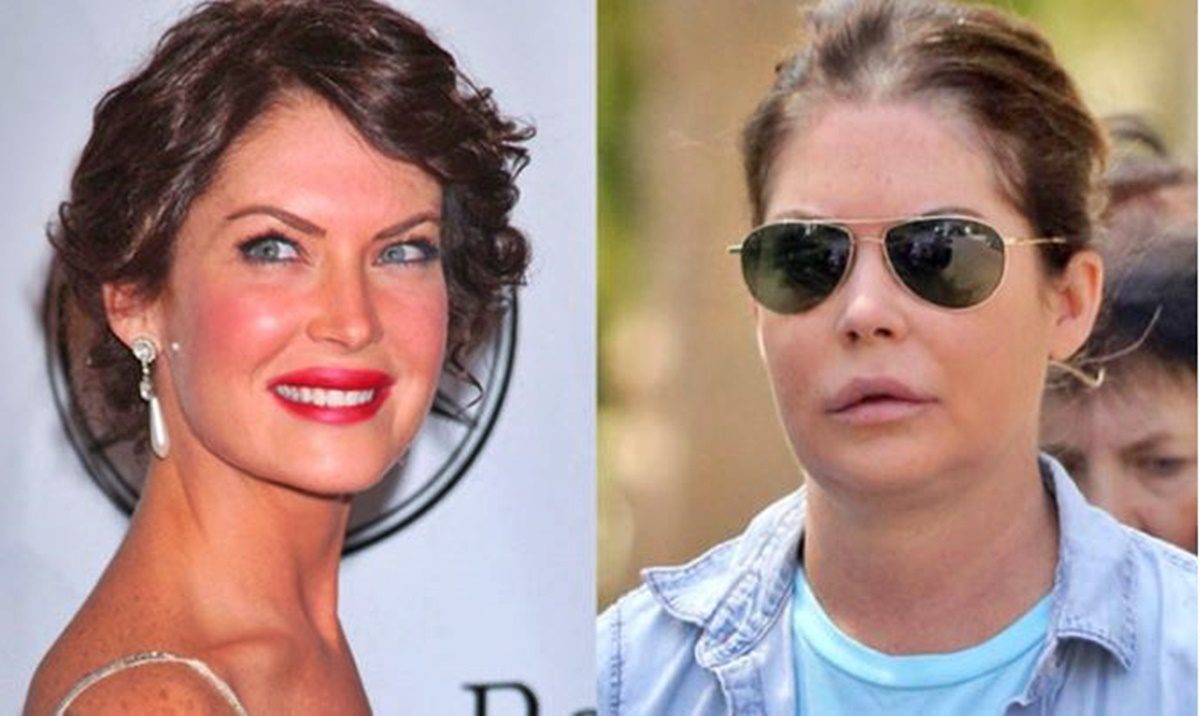 Színésznők, akik már biztos megbánták, hogy plasztikáztatták az arcukat: szerinted kinek a műtétje sikerült legrosszabbul?
