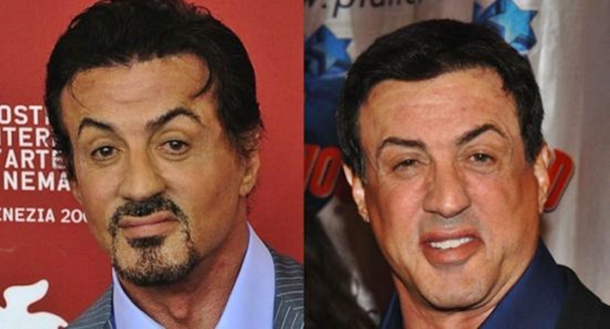 Ma már alig hasonlít a régi énjére - Sylvester Stallone arca durván szét van műtve